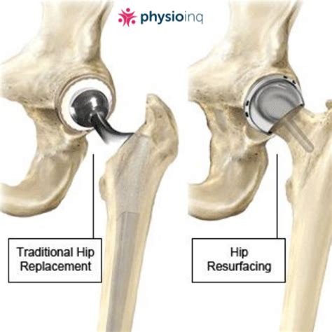 What is a hip Resurfacing Procedure?