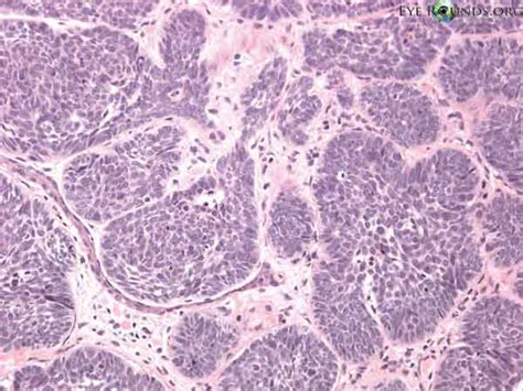 Basal cell carcinoma (nodular type). Histology