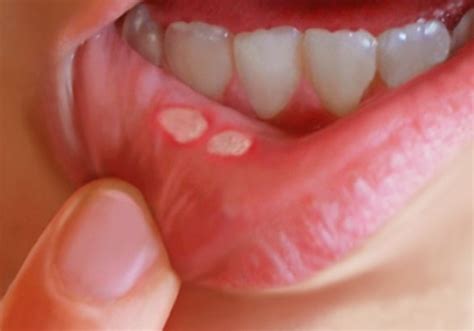 Blisters in Mouth - Symptoms, Treatment, Causes, Pictures | hubpages
