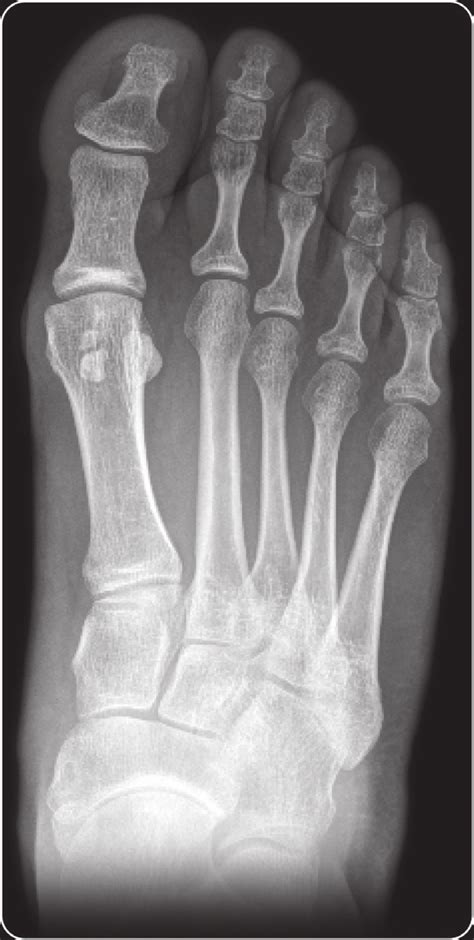 AP X-ray. Moderate hallux valgus. | Download Scientific Diagram