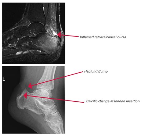 Achilles Tendinopathy | Mr Daniel Goldbloom | Melbourne