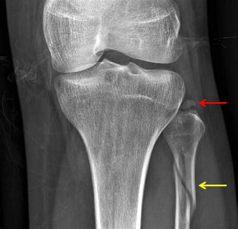 Fibular Avulsion Fracture