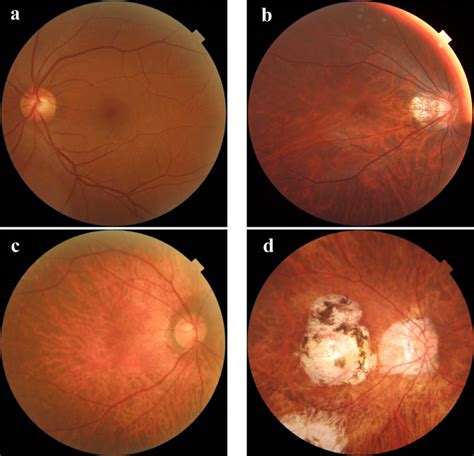 Typical fundus photographs of four categories. a Normal or mild ...