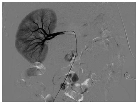 Selective right renal angiogram shows no obvious bleeding from the... | Download Scientific Diagram