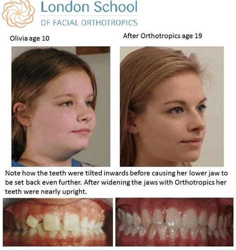 Some results of orthotropic practices that I found online : orthotropics