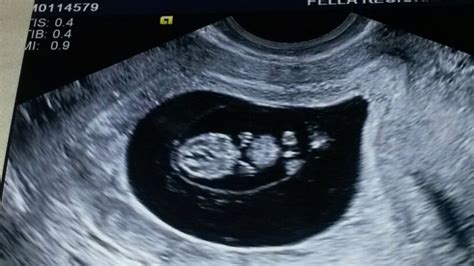 9 week ultrasound boy or girl? | BabyCenter