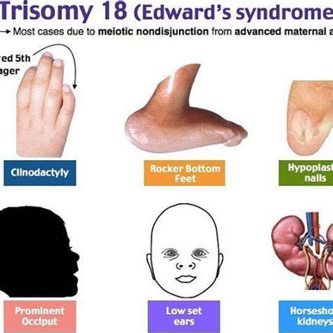 Trisomy 18 (Edward's Syndrome) | Edwards syndrome, Diagnostic medical ...