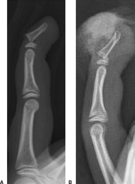 Figure 1 from Seymour fractures: retrospective analysis and therapeutic ...