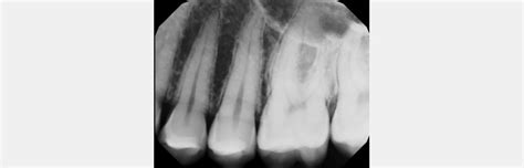 Identifying Pulpal Necrosis for Endodontic Treatment - Spear Education