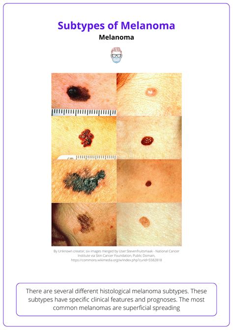 Melanoma: Diagnosis, Features, Sentinel Node, & Staging