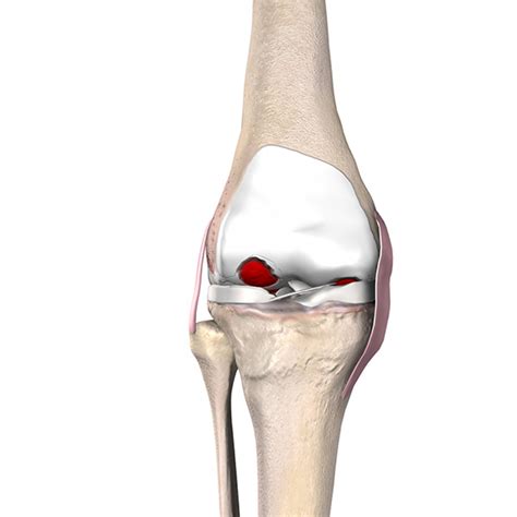 Knee Replacement Surgery | PCI Orthopedics | Eastern Iowa