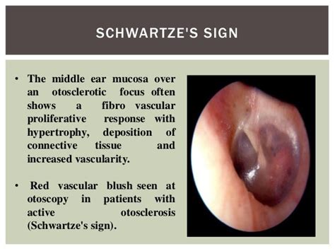 Otosclerosis