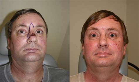 Nasal Skin Cancer Reconstruction