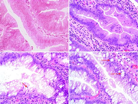 Traditional serrated adenoma (TSA): morphological questions, queries and quandaries | Journal of ...