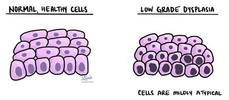 Displasia de bajo grado | MyPathologyReport.ca