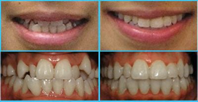 Types Of Teeth Shapes