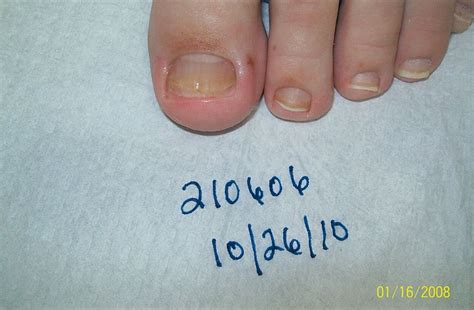 Toenail Fungus Before and After Photos - Advanced Podiatry of Manhasset ...