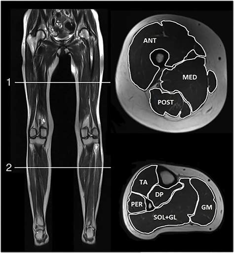 Frontiers | Quantitative Muscle MRI and Clinical Findings in Women With Pathogenic Dystrophin ...