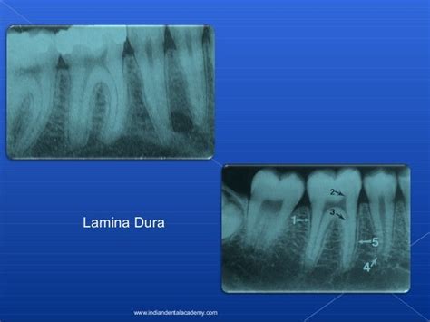 Lamina dura/ oral surgery courses