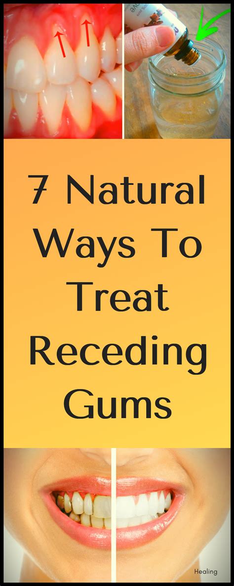 7 Natural Ways To Treat Receding Gums | Receding gums, Oral health, Dental health care