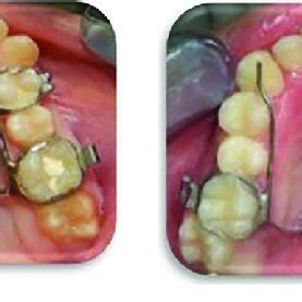 (a) Quad helix maxillary expander used in the study; (b) Hyrax ...