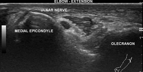 Anconeus Epitrochlearis Muscle