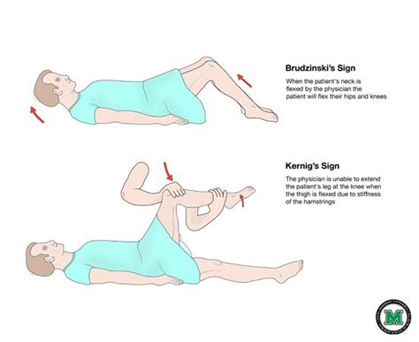 Kernig and Brudzinski Signs-MU-thumb.jpg 550×450 pixels Tests for meningitis | Pediatric nurse ...