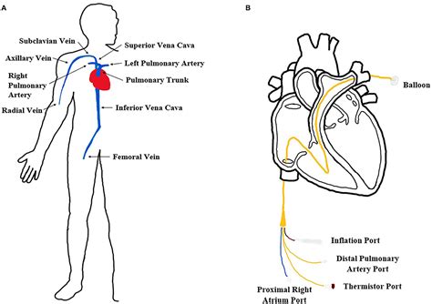 Pulmonary Artery Catheter Wikipedia, 40% OFF