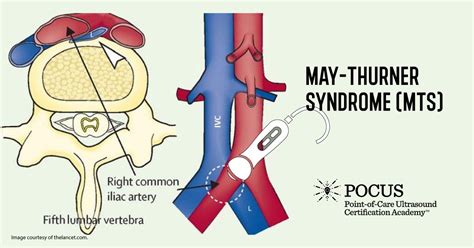 May-Thurner Syndrome (MTS) | Point-of-Care Ultrasound Certification Academy