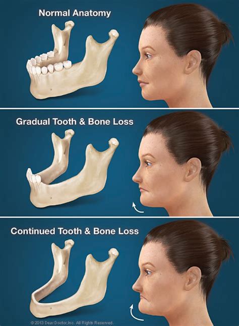 jaw-bone-loss – Britten Perio