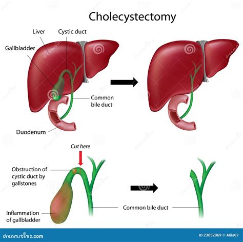 Laparoscopic Cholecystectomy Anatomy