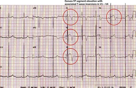 A black athlete's ECG showing ethnic-specific repolarization changes ...