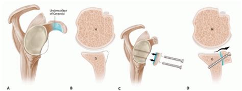 Latarjet Procedure for Instability with Bone Loss | Musculoskeletal Key