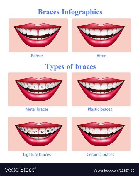 Teeth braces types realistic infographics Vector Image