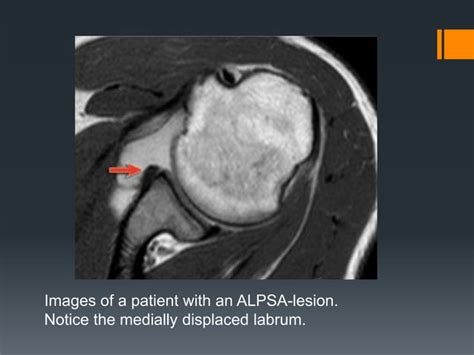 Shoulder labral tears MRI