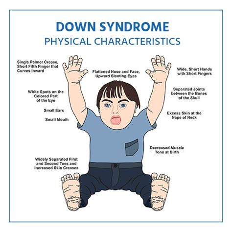 down syndrome. Down syndrome, also known as trisomy… | by Magdyos Tech ...