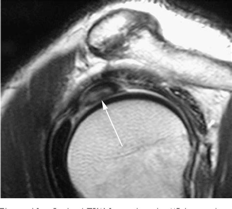 [PDF] MRI of the rotator interval of the shoulder. | Semantic Scholar