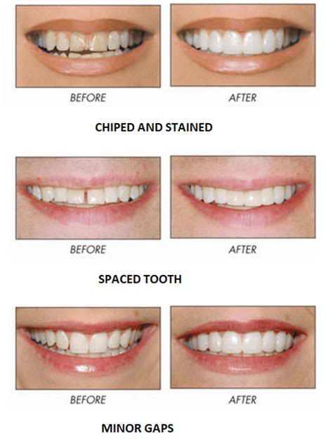 Dental Adhesive For Crowns | Composite Teeth Charlotte | Dental