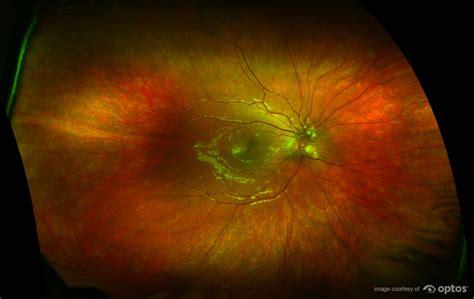 Optomap Retinal Exam – ELITE FAMILY VISION