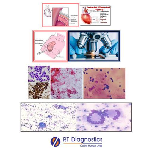 Cytology - Pericardial Fluid | RT Diagnostics