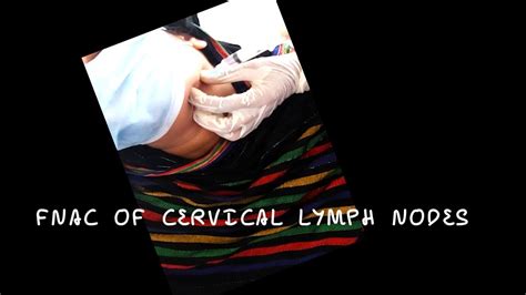 FNAC of Cervical Lymph Nodes।। - YouTube