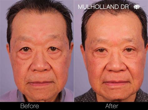 Asian Blepharoplasty - Patient 2 - Spamedica