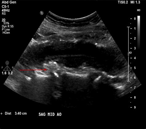 Abdominal Aortic Aneurysm Ultrasound