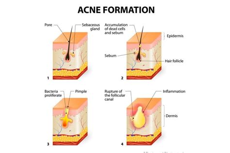 Cystic Acne: Causes, Prevention & Treatment