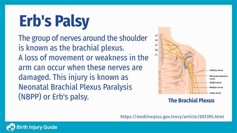 Erb's Palsy: Causes, Symptoms and Treatment - Birth Injury Guide