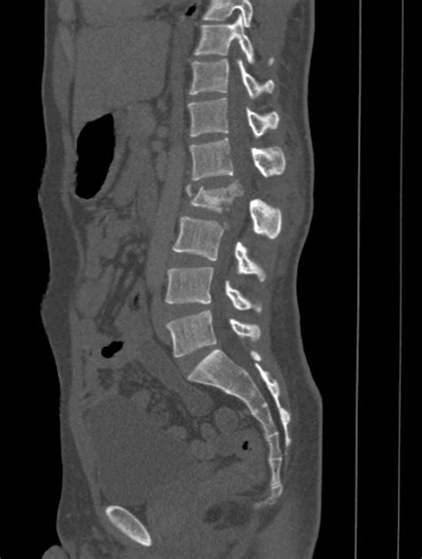 Spinal cord compression CT - wikidoc