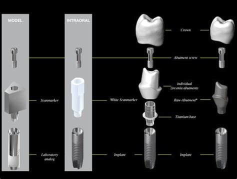 Types of Abutment