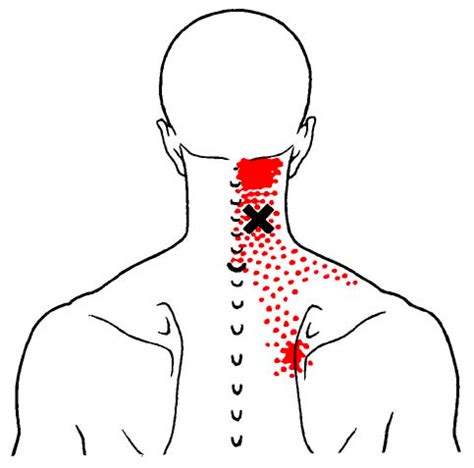 What are Muscle Knots and How Can we Prevent Them? - Back to Health Physiotherapy