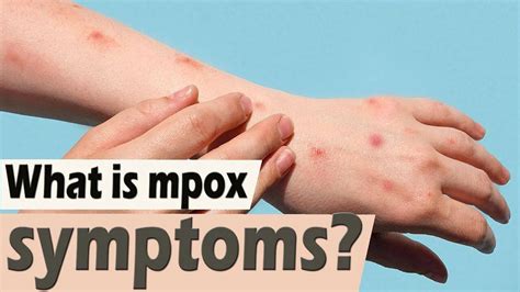 What is mpox symptoms? What causes mpox positive?