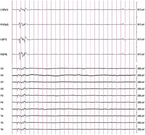 Sample isoelectric EEG. Simultaneous Sedline EEG (top) and 10-lead EEG... | Download Scientific ...